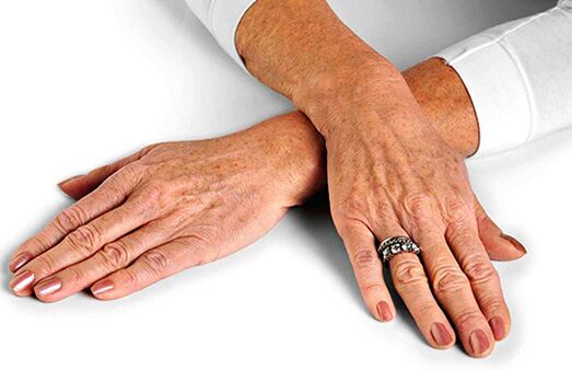 Koža ruku s promjenama vezanim za starenje koje zahtijevaju korištenje tehnika pomlađivanja