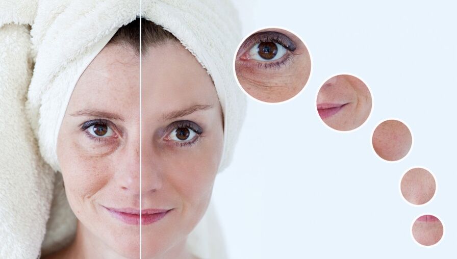 prije i poslije pomlađivanja kože plazmom