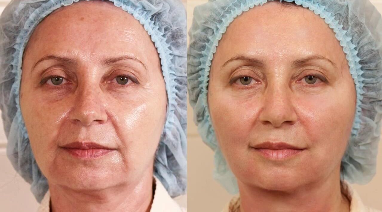 fotografije prije i poslije faceliftinga