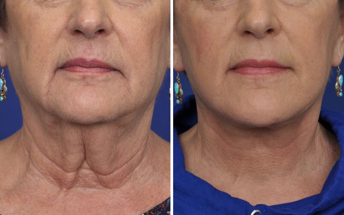 prije i poslije postupaka pomlađivanja kože