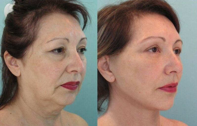 Rezultat pomlađivanja kože lica zatezanjem nitima