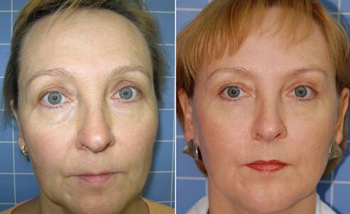 Prije i poslije frakcijskog laserskog pomlađivanja lica