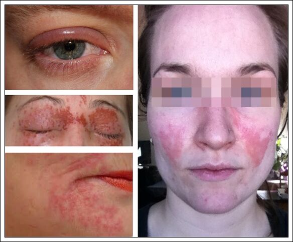 alergija na maske protiv starenja