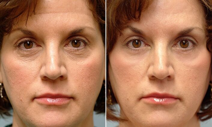 lice prije i poslije frakcijskog pomlađivanja laserom